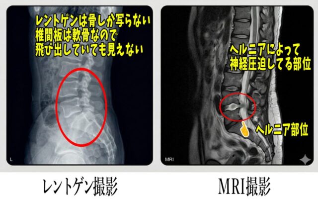 奈良市で腰椎椎間板ヘルニアでお困りの方はえにし堂鍼灸整骨院がおすすめ